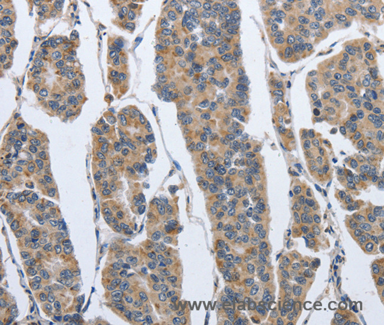 Immunohistochemistry of paraffin-embedded Human breast cancer using IPO7 Polyclonal Antibody at dilution of 1:40