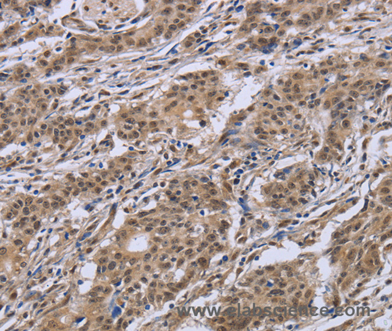 Immunohistochemistry of paraffin-embedded Human gastric cancer tissue using IPO8 Polyclonal Antibody at dilution 1:50