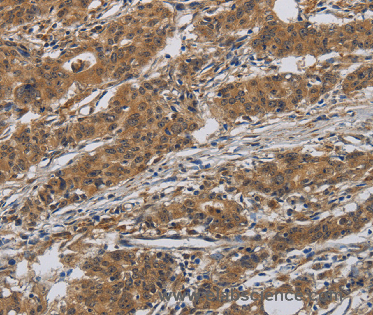 Immunohistochemistry of paraffin-embedded Human gasrtic cancer tissue using INPPL1 Polyclonal Antibody at dilution 1:40