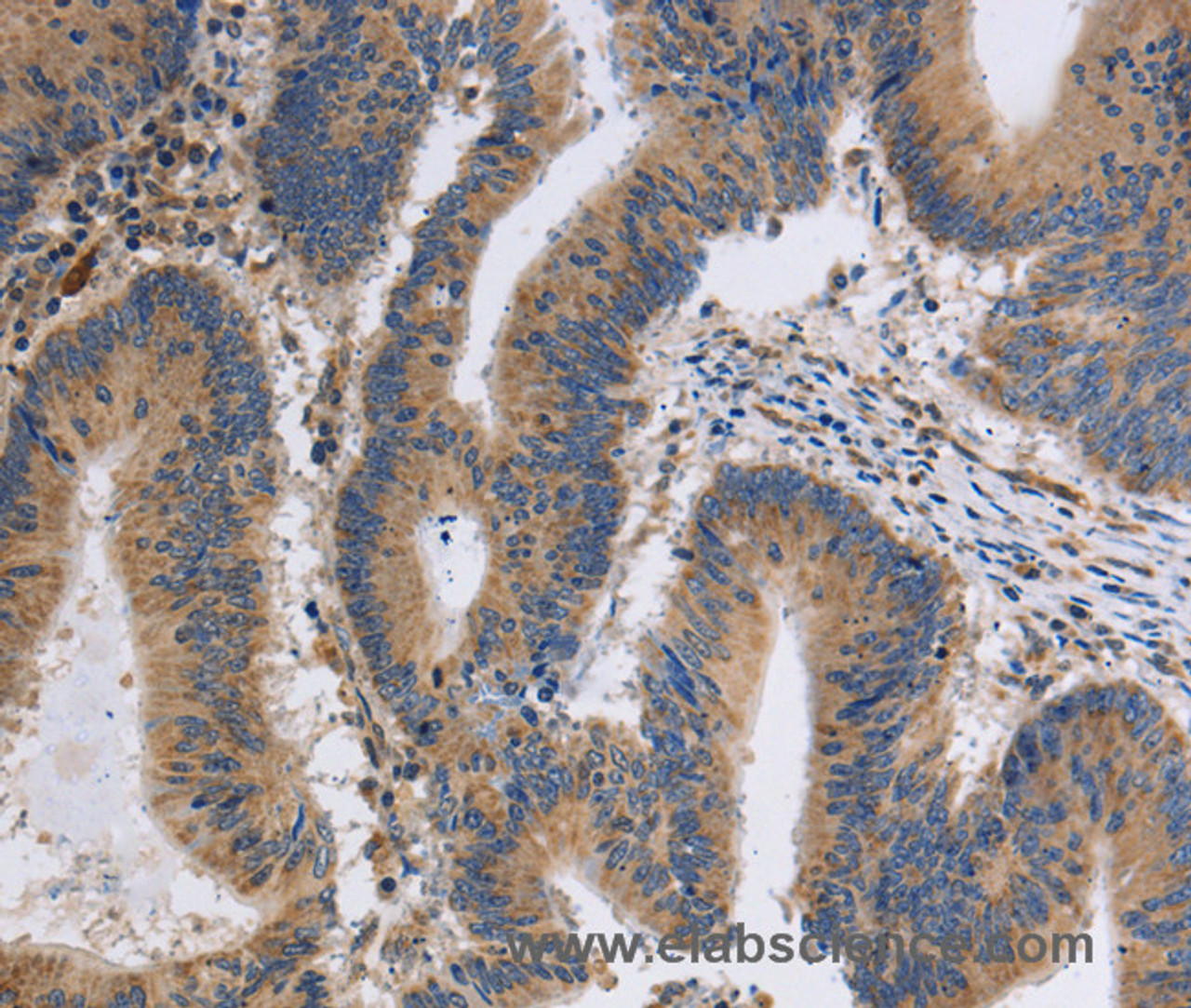 Immunohistochemistry of paraffin-embedded Human colon cancer tissue using ITPR1 Polyclonal Antibody at dilution 1:40