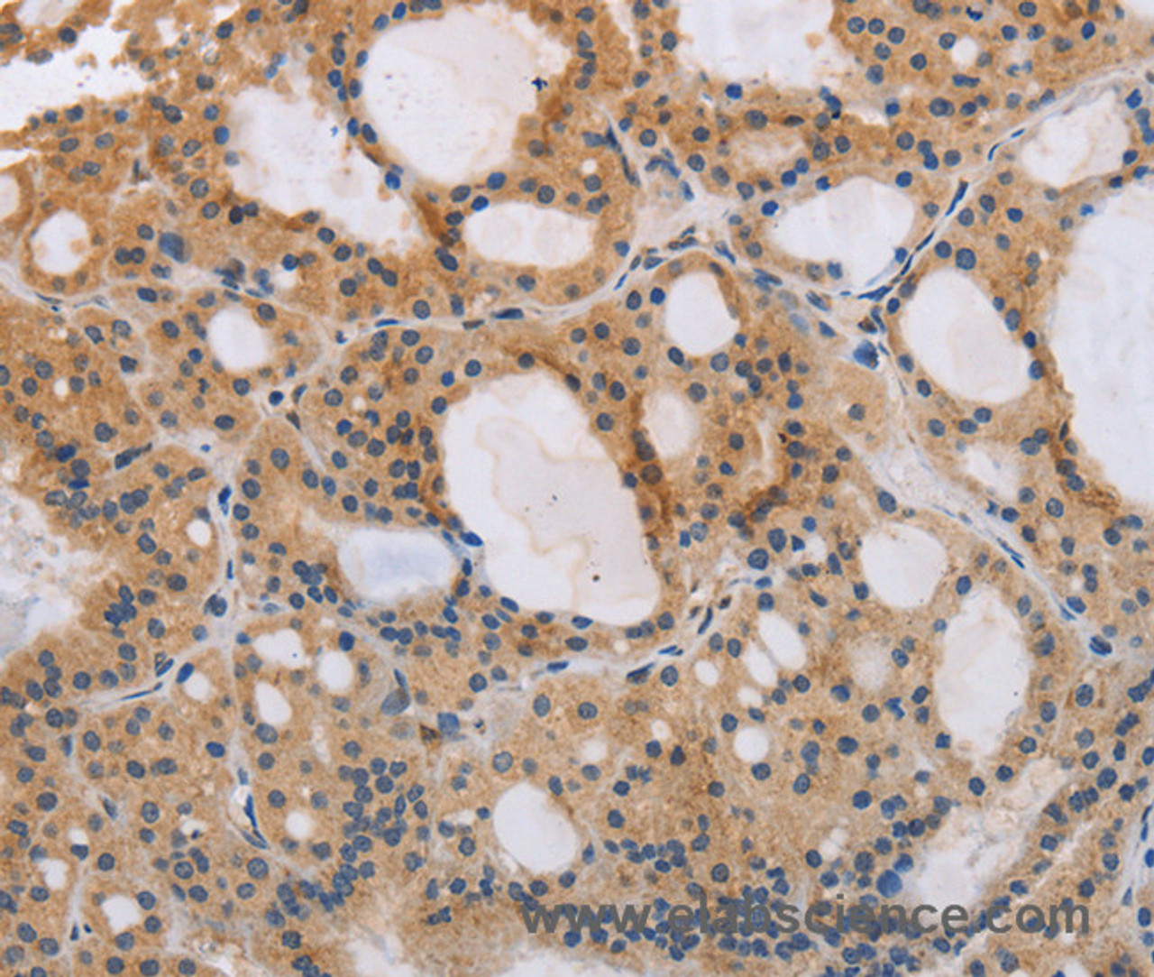 Immunohistochemistry of paraffin-embedded Human thyroid cancer tissue using ITPR1 Polyclonal Antibody at dilution 1:40