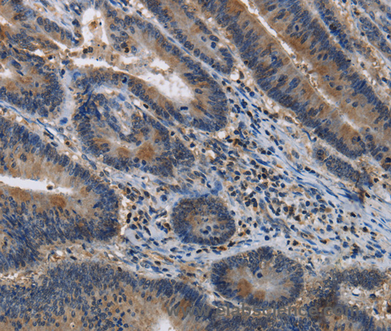 Immunohistochemistry of paraffin-embedded Human colon cancer tissue using ITPR2 Polyclonal Antibody at dilution 1:40