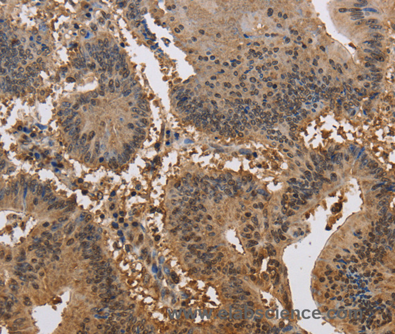 Immunohistochemistry of paraffin-embedded Human colon cancer tissue using JAG2 Polyclonal Antibody at dilution 1:30