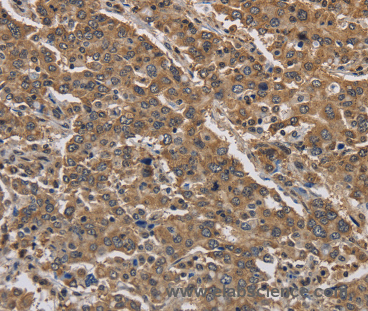 Immunohistochemistry of paraffin-embedded Human liver cancer tissue using JAG2 Polyclonal Antibody at dilution 1:30
