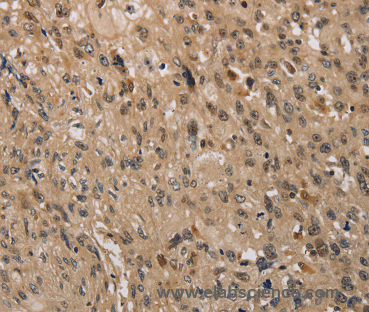Immunohistochemistry of paraffin-embedded Human esophagus cancer using KDM4A Polyclonal Antibody at dilution of 1:40