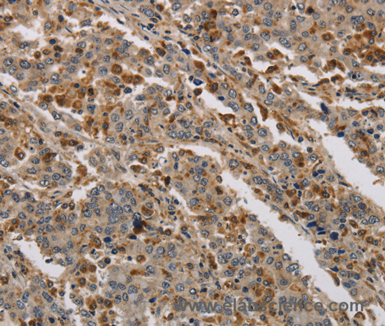 Immunohistochemistry of paraffin-embedded Human liver cancer using KDM4A Polyclonal Antibody at dilution of 1:40