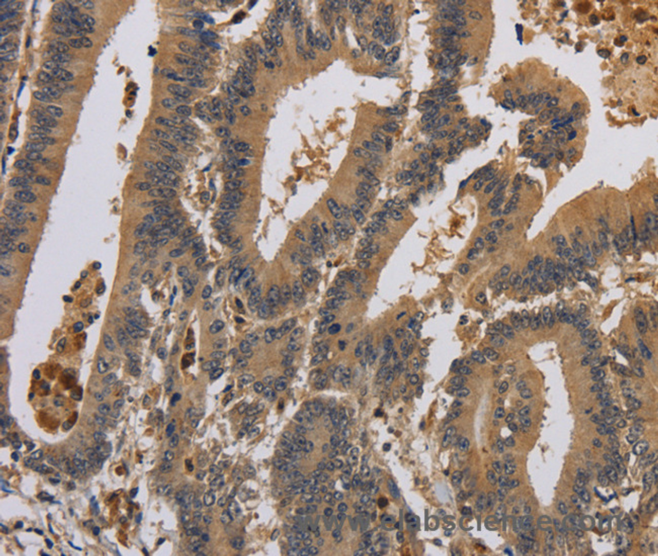 Immunohistochemistry of paraffin-embedded Human colon cancer using KCNA7 Polyclonal Antibody at dilution of 1:40