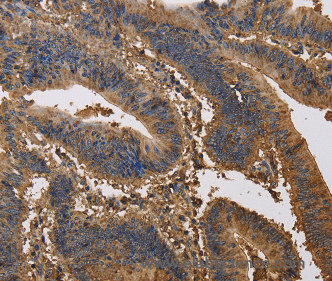 Immunohistochemistry of paraffin-embedded Human colon cancer tissue using KCNG1 Polyclonal Antibody at dilution 1:40