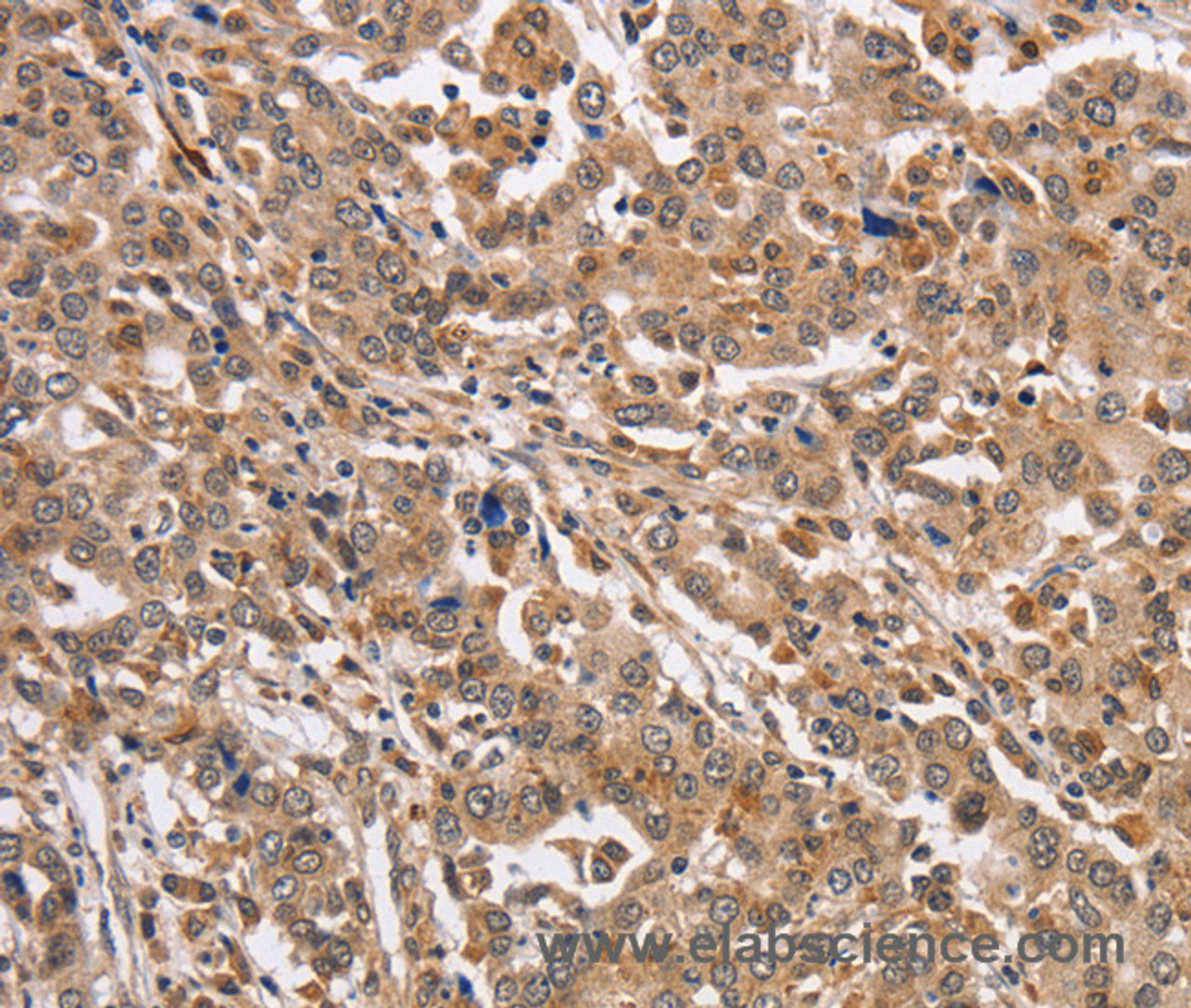 Immunohistochemistry of paraffin-embedded Human liver cancer using KCNG2 Polyclonal Antibody at dilution of 1:40
