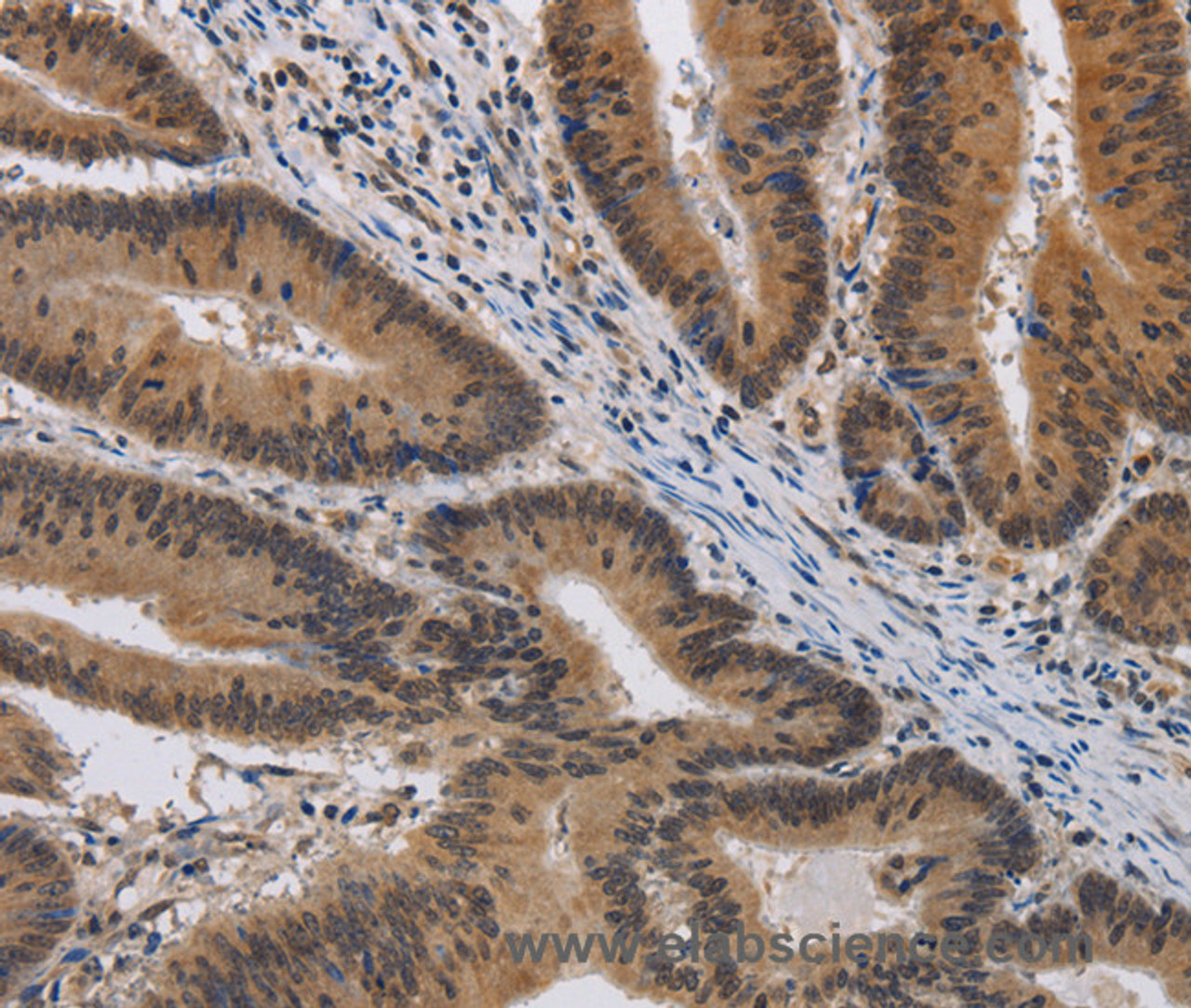 Immunohistochemistry of paraffin-embedded Human colon cancer using KCNG4 Polyclonal Antibody at dilution of 1:40
