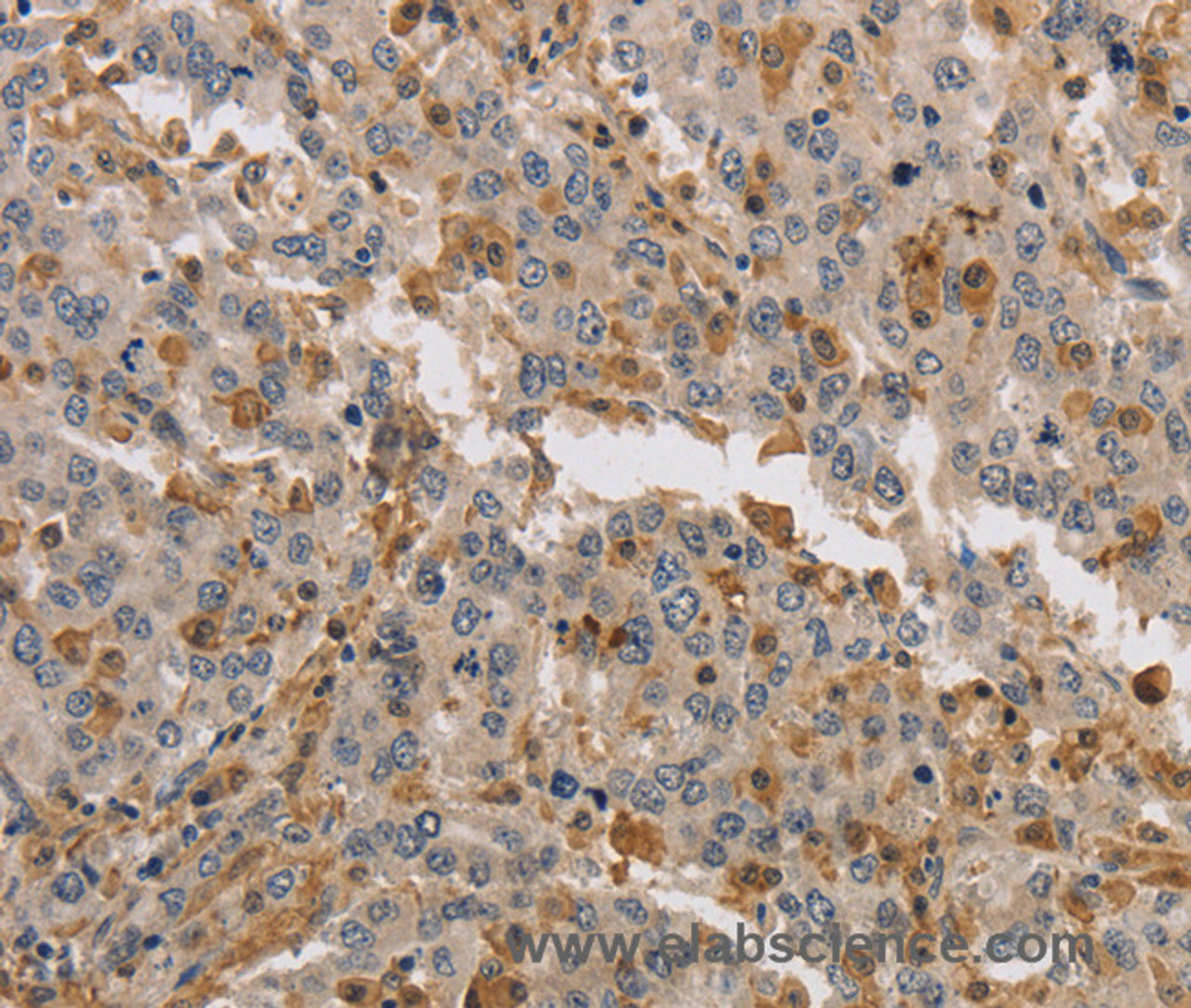 Immunohistochemistry of paraffin-embedded Human liver cancer tissue using KIF17 Polyclonal Antibody at dilution 1:40