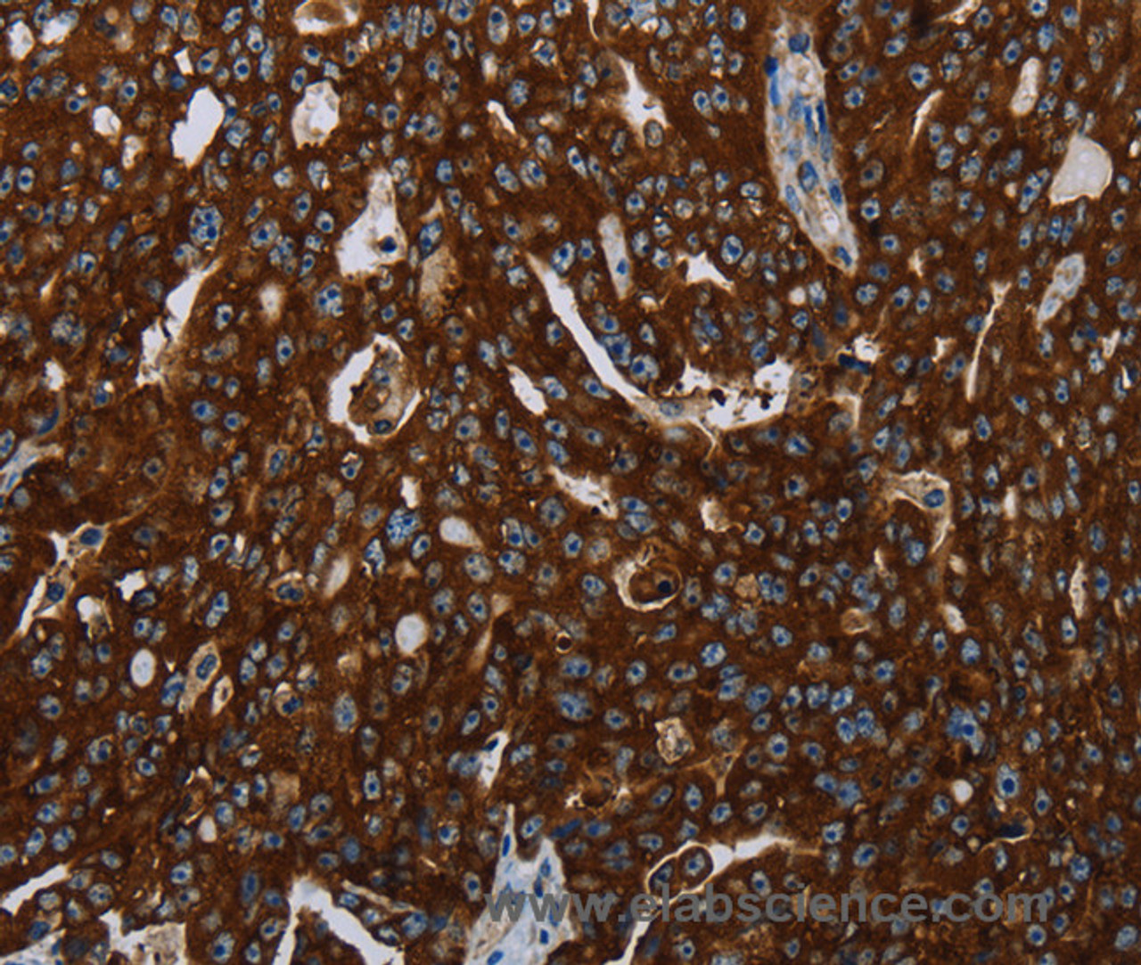 Immunohistochemistry of paraffin-embedded Human ovarian cancer tissue using KISS1R Polyclonal Antibody at dilution 1:30