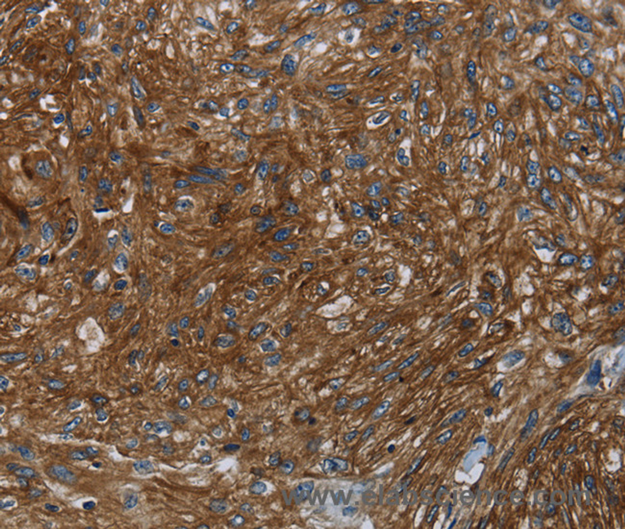 Immunohistochemistry of paraffin-embedded Human esophagus cancer tissue using KISS1R Polyclonal Antibody at dilution 1:30