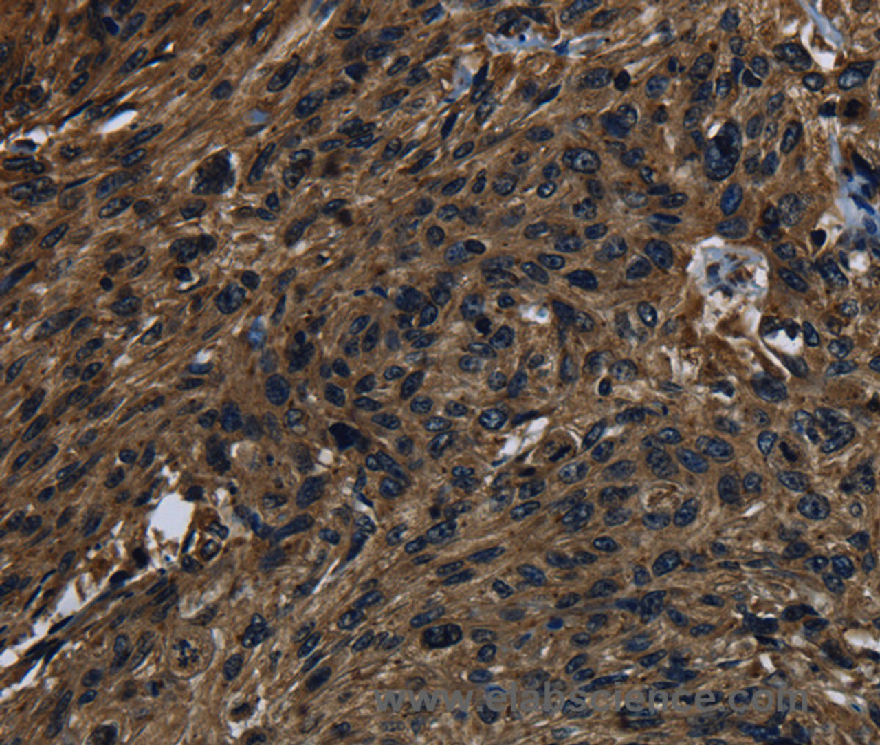 Immunohistochemistry of paraffin-embedded Human esophagus cancer using KLK14 Polyclonal Antibody at dilution of 1:40