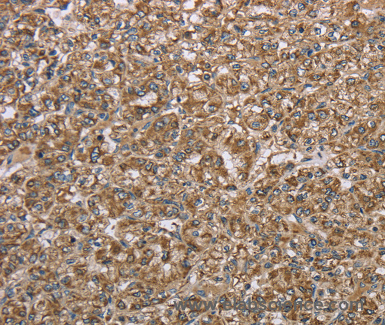 Immunohistochemistry of paraffin-embedded Human prostate cancer using CERS4 Polyclonal Antibody at dilution of 1:35