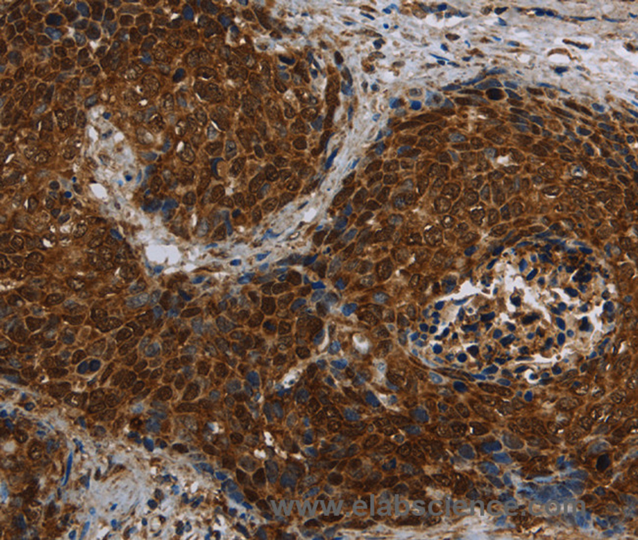 Immunohistochemistry of paraffin-embedded Human cervical cancer tissue using CERS5 Polyclonal Antibody at dilution 1:40