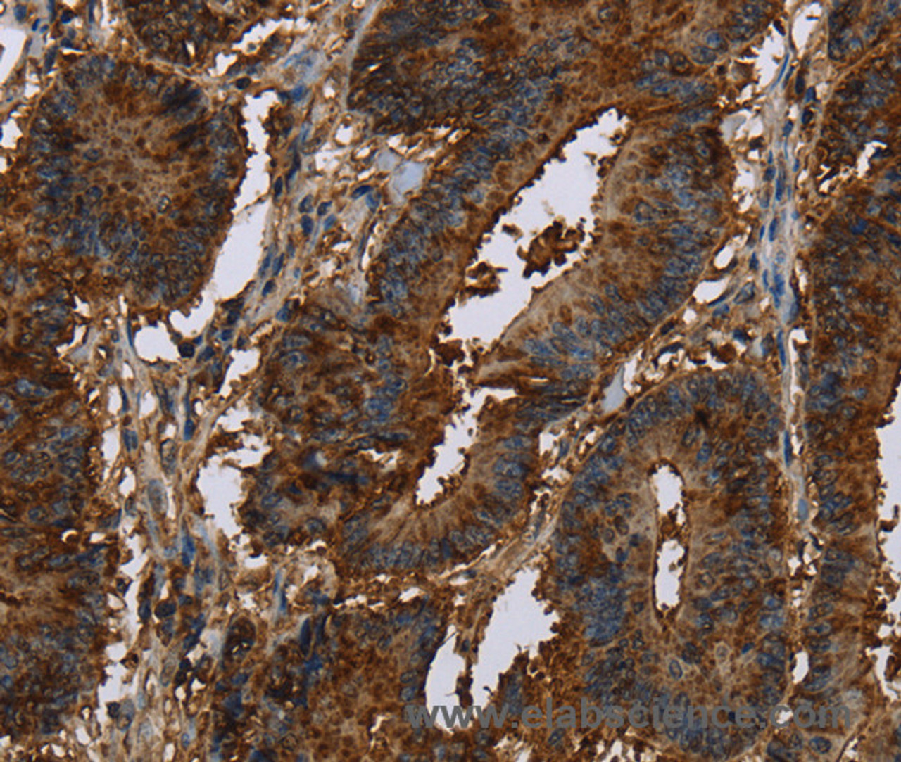 Immunohistochemistry of paraffin-embedded Human colon cancer tissue using CERS5 Polyclonal Antibody at dilution 1:40