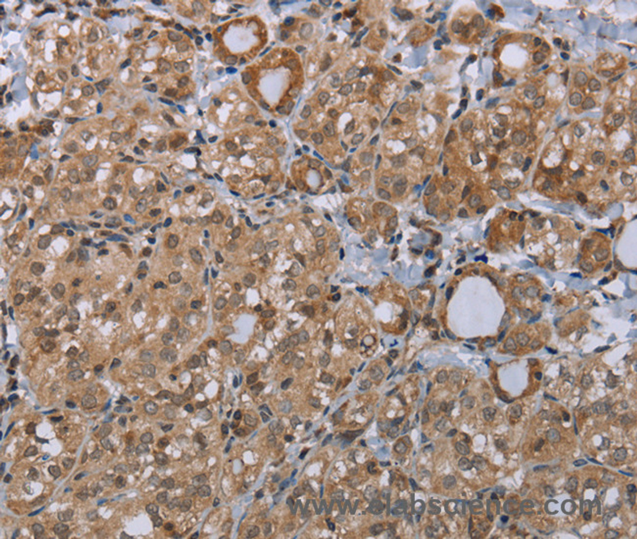 Immunohistochemistry of paraffin-embedded Human thyroid cancer tissue using LIMK1 Polyclonal Antibody at dilution 1:40