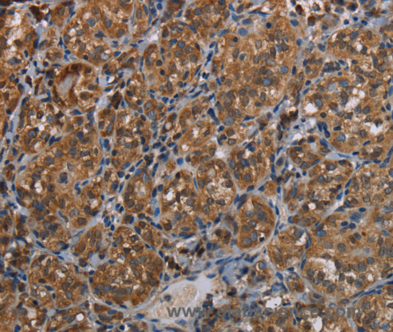 Immunohistochemistry of paraffin-embedded Human thyroid cancer tissue using LLGL1 Polyclonal Antibody at dilution 1:40