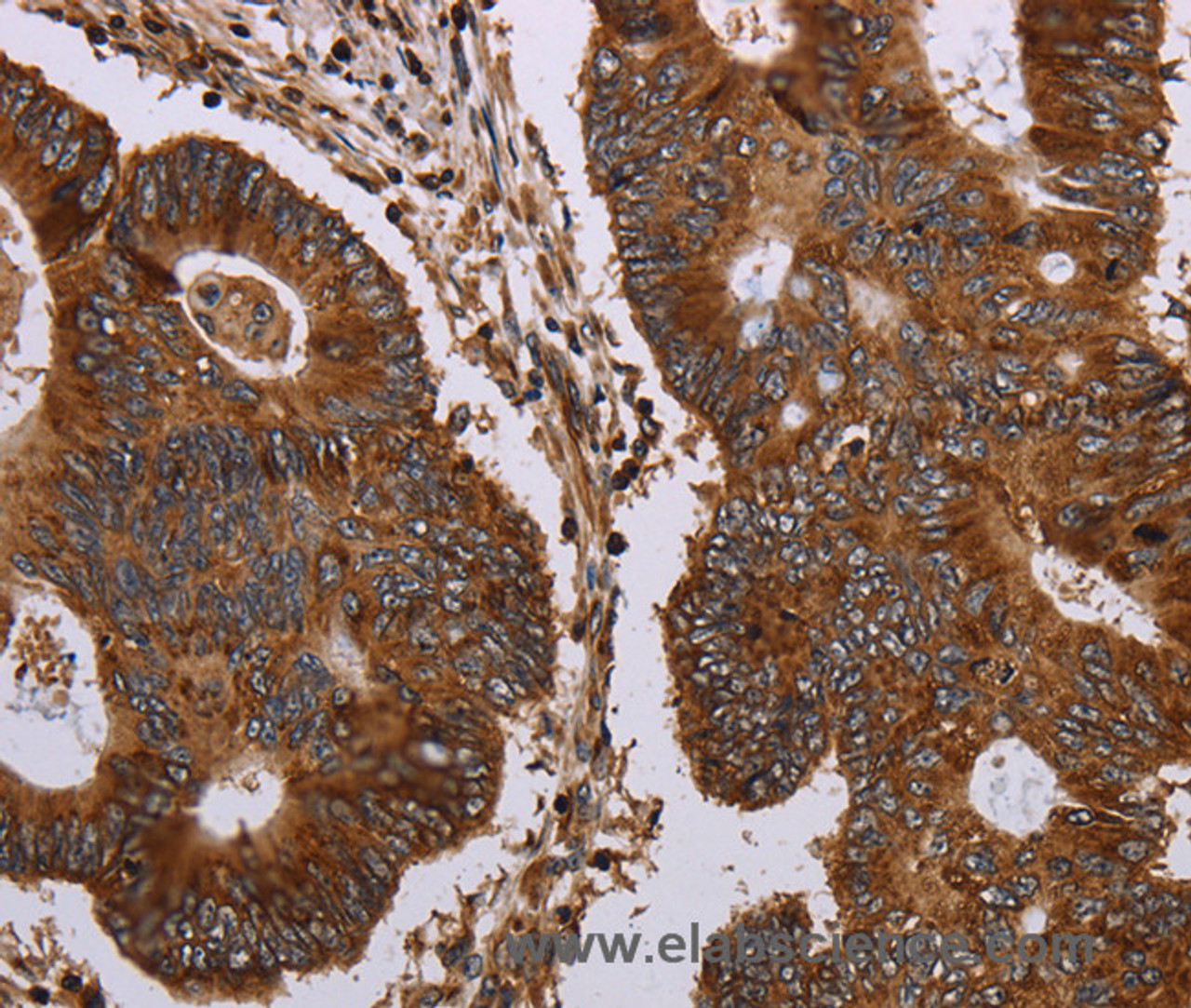 Immunohistochemistry of paraffin-embedded Human colon cancer tissue using MAGEC2 Polyclonal Antibody at dilution 1:40