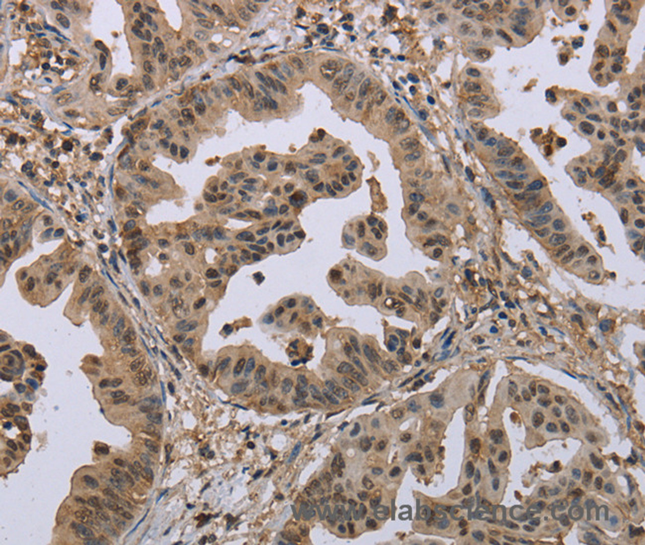 Immunohistochemistry of paraffin-embedded Human gastric cancer tissue using MCC Polyclonal Antibody at dilution 1:30