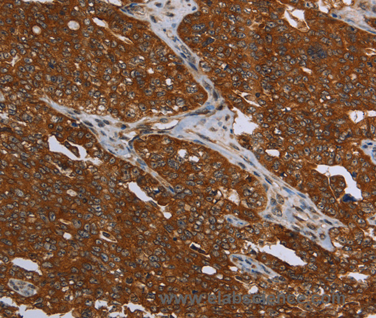 Immunohistochemistry of paraffin-embedded Human ovarian cancer using MCHR1 Polyclonal Antibody at dilution of 1:30