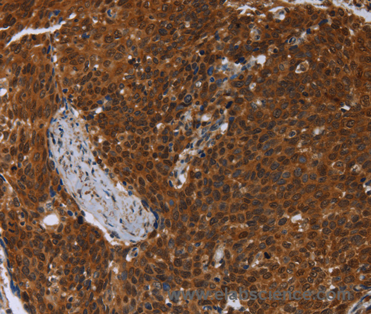 Immunohistochemistry of paraffin-embedded Human cervical cancer using MCHR1 Polyclonal Antibody at dilution of 1:30