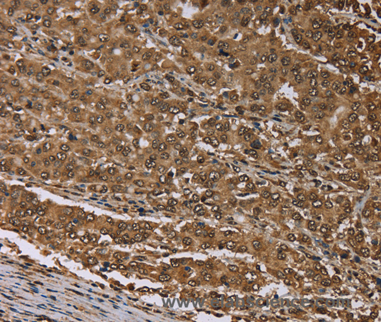 Immunohistochemistry of paraffin-embedded Human liver cancer tissue using MEIS1 Polyclonal Antibody at dilution 1:30