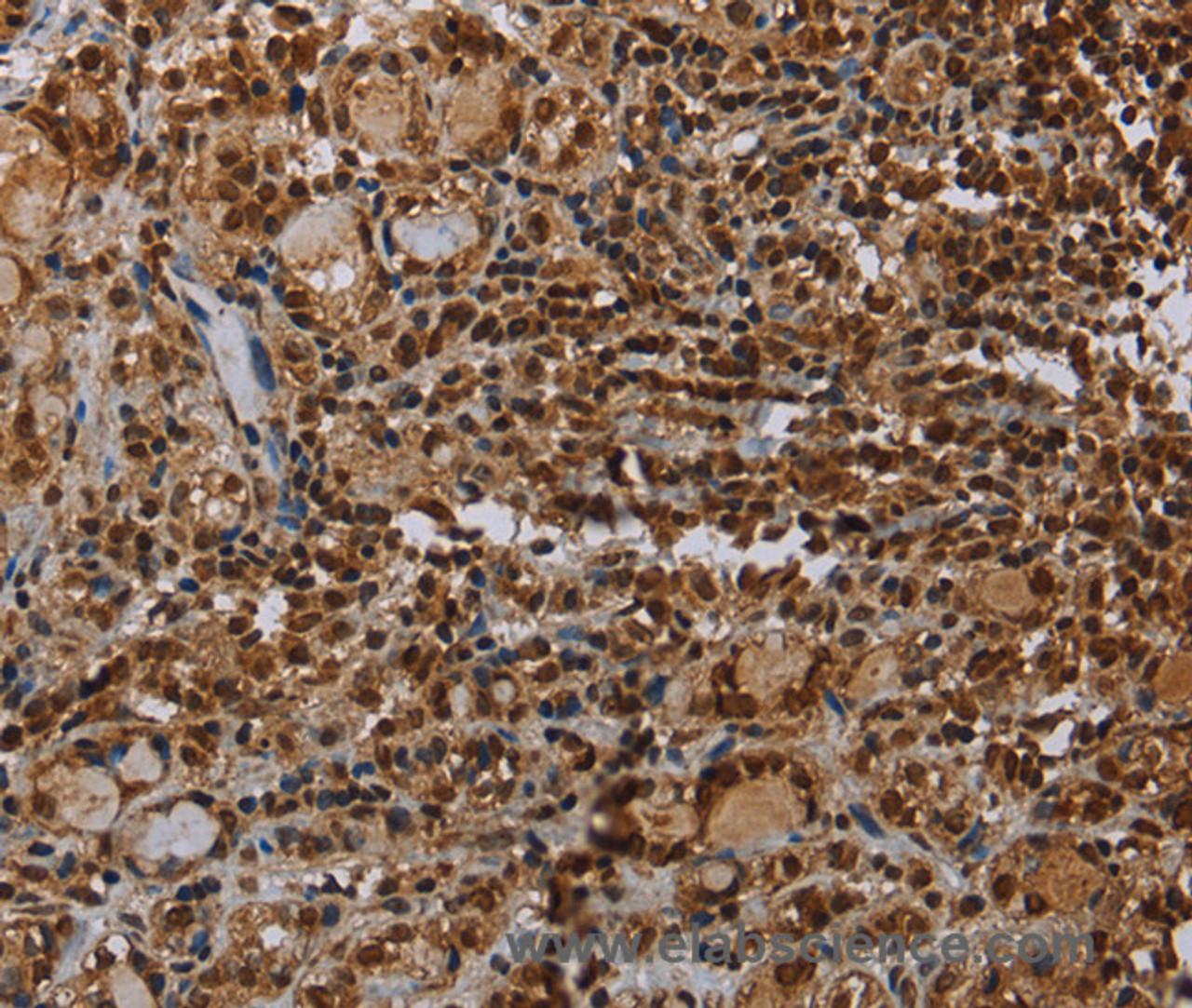 Immunohistochemistry of paraffin-embedded Human thyroid cancer using TBX5 Polyclonal Antibody at dilution of 1:35