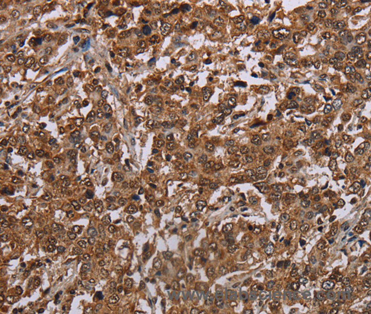 Immunohistochemistry of paraffin-embedded Human liver cancer using TBX5 Polyclonal Antibody at dilution of 1:35