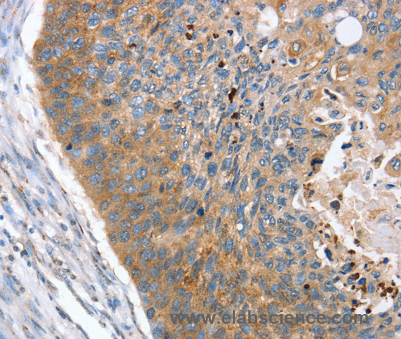 Immunohistochemistry of paraffin-embedded Human esophagus cancer using REG3A Polyclonal Antibody at dilution of 1:40