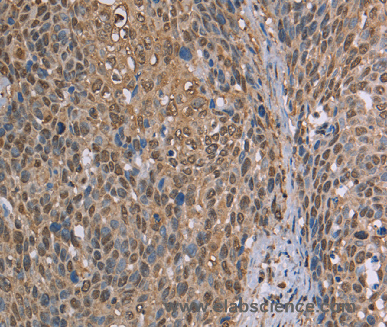 Immunohistochemistry of paraffin-embedded Human cervical cancer using CAB39 Polyclonal Antibody at dilution of 1:50