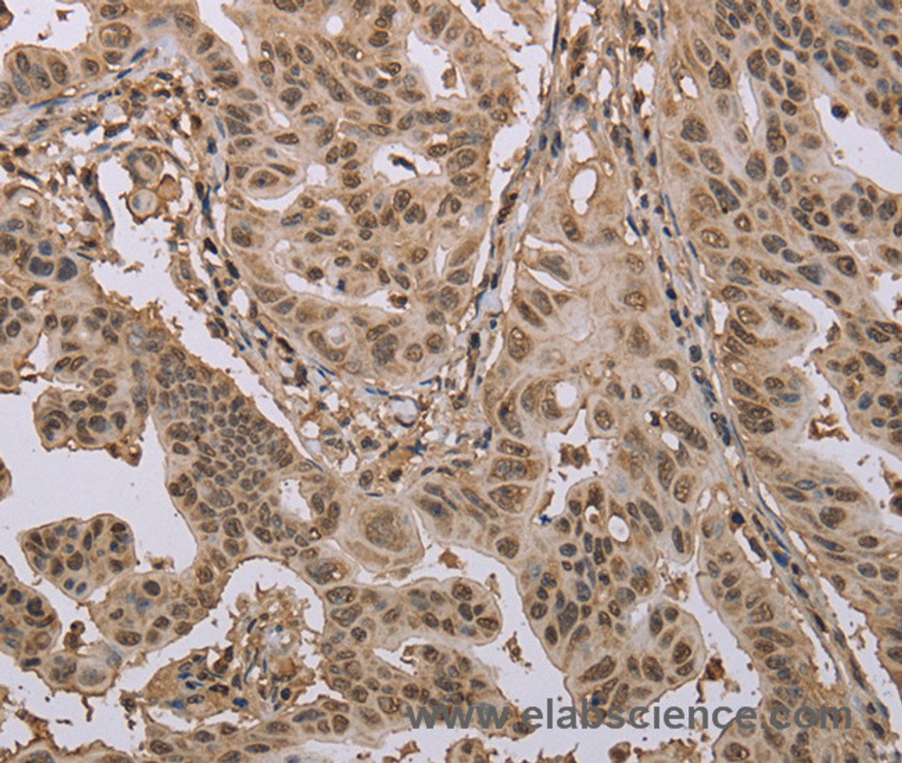 Immunohistochemistry of paraffin-embedded Human gastric cancer using CAB39 Polyclonal Antibody at dilution of 1:50