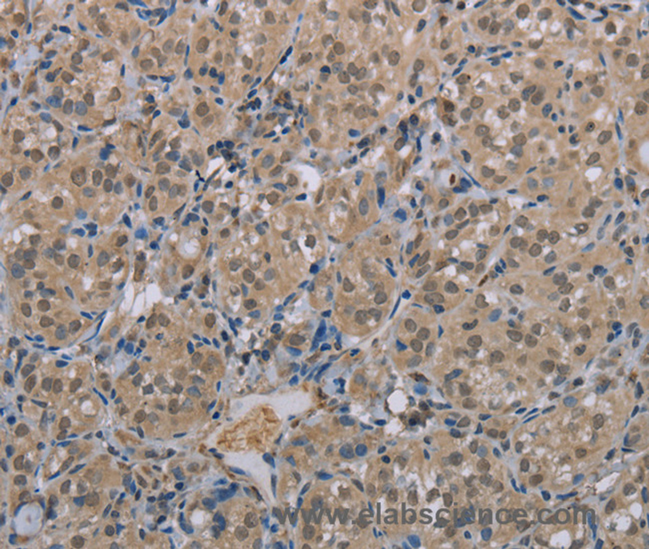 Immunohistochemistry of paraffin-embedded Human thyroid cancer tissue using MGLL Polyclonal Antibody at dilution 1:40