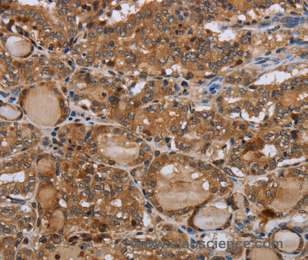 Immunohistochemistry of paraffin-embedded Human thyroid cancer using MT-ND1 Polyclonal Antibody at dilution of 1:50
