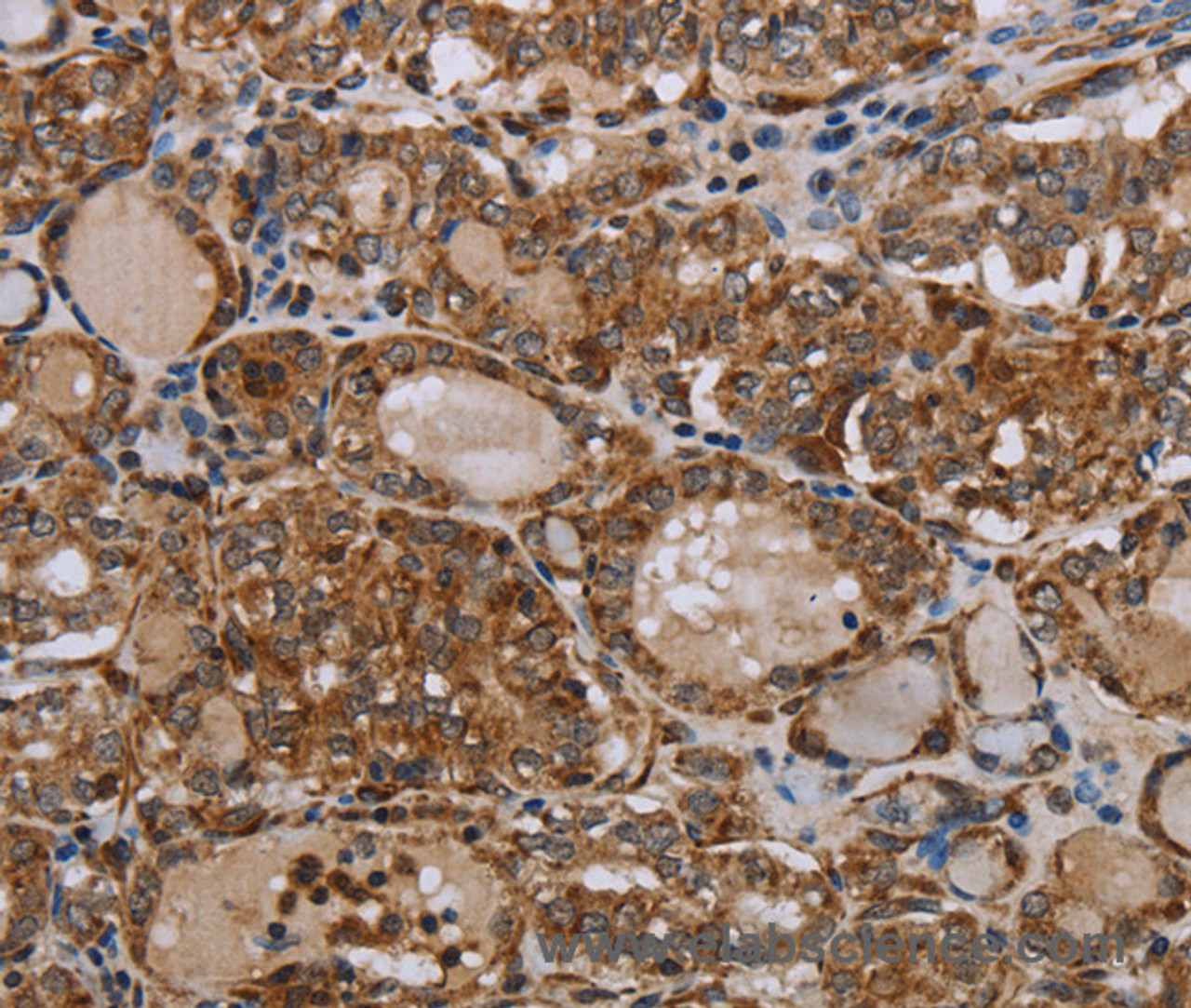 Immunohistochemistry of paraffin-embedded Human thyroid cancer tissue using MT-ND6 Polyclonal Antibody at dilution 1:40