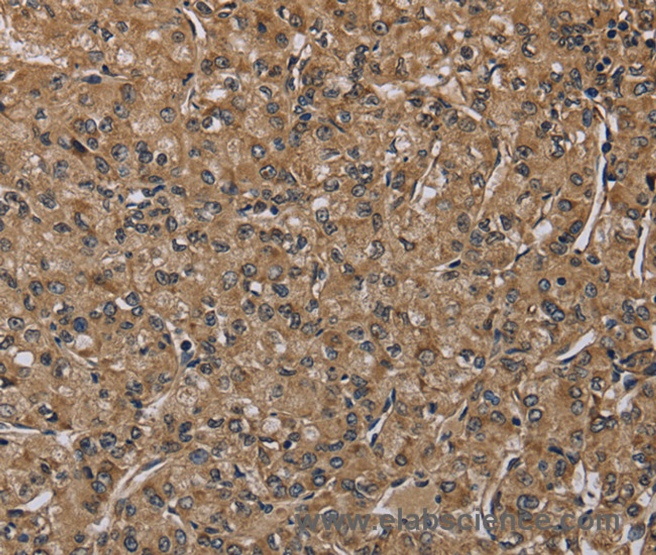 Immunohistochemistry of paraffin-embedded Human prostate cancer tissue using NLRP4 Polyclonal Antibody at dilution 1:40