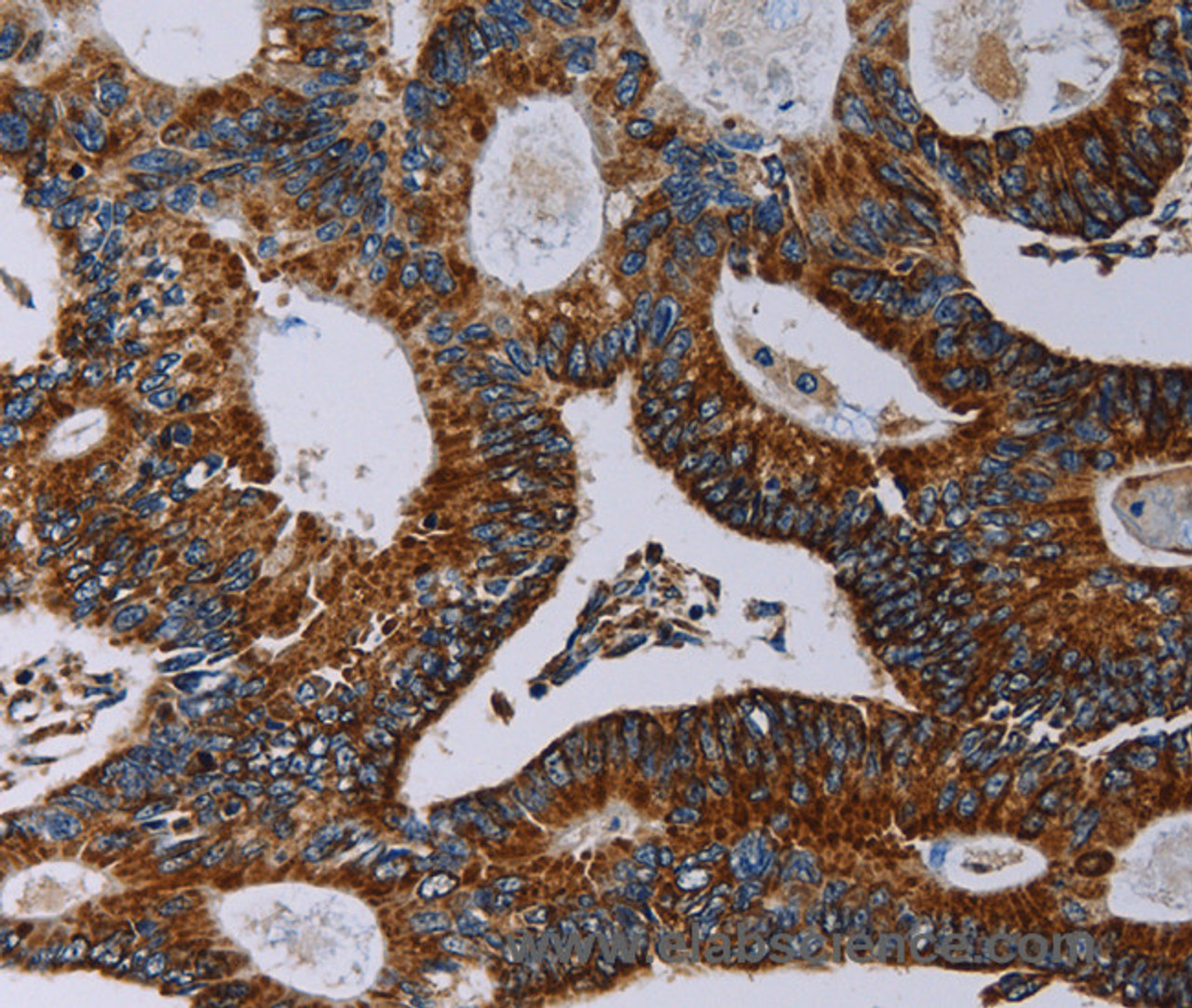 Immunohistochemistry of paraffin-embedded Human colon cancer using NDUFA4 Polyclonal Antibody at dilution of 1:40