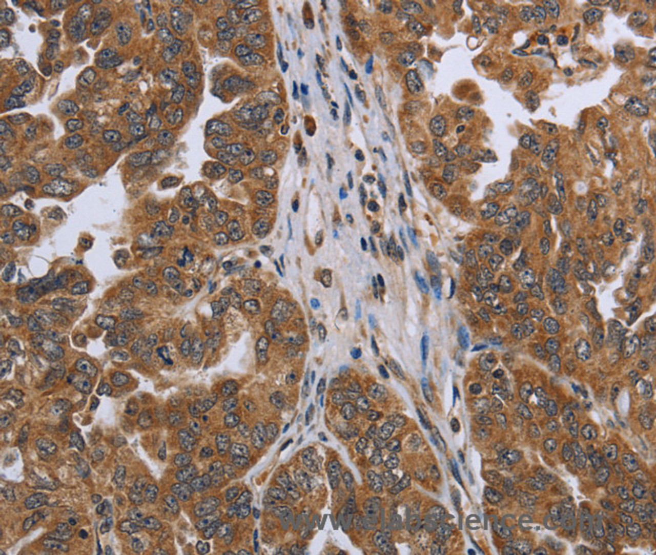 Immunohistochemistry of paraffin-embedded Human ovarian cancer using NDUFAF4 Polyclonal Antibody at dilution of 1:45