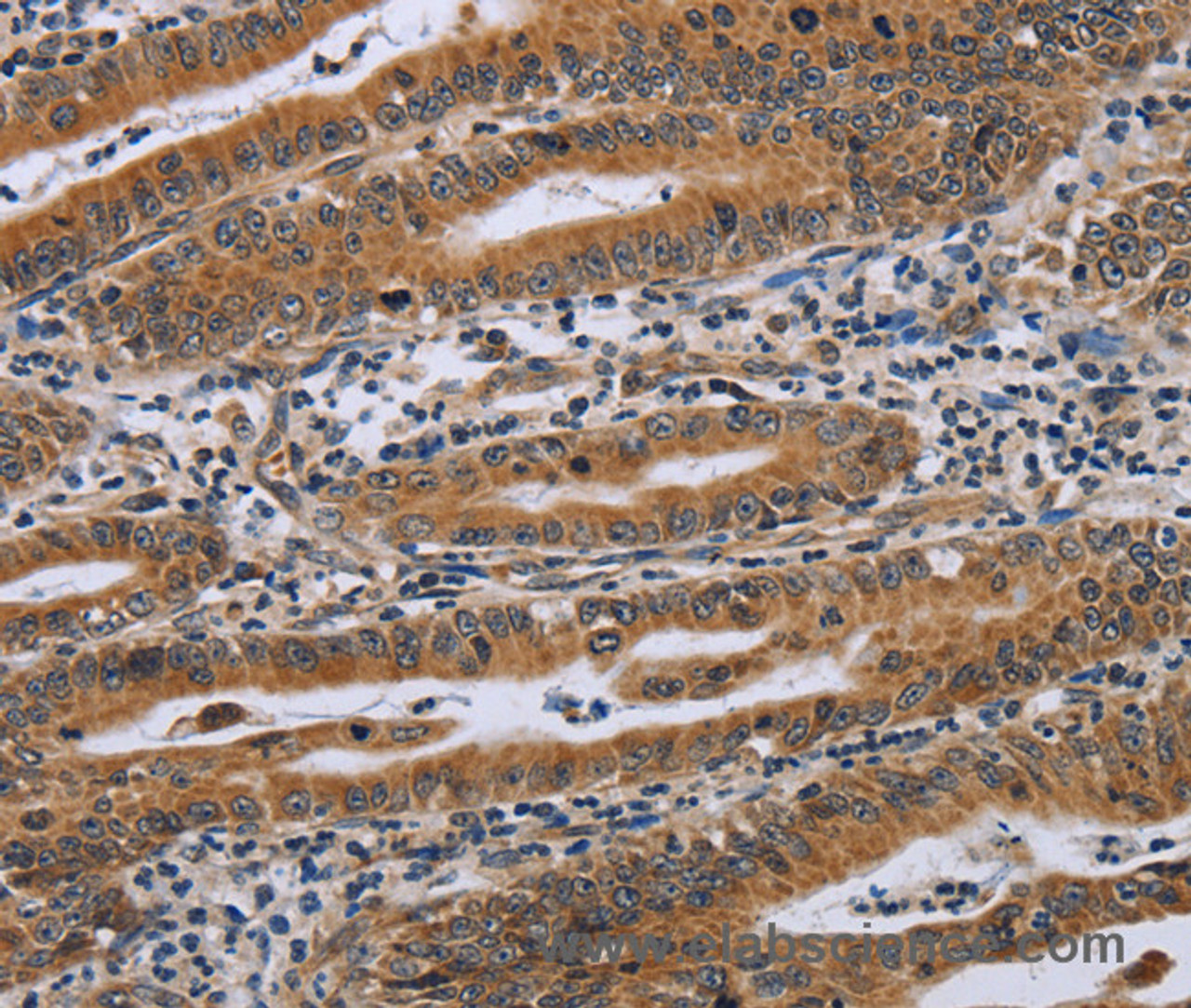 Immunohistochemistry of paraffin-embedded Human gastric cancer using NDUFAF4 Polyclonal Antibody at dilution of 1:45