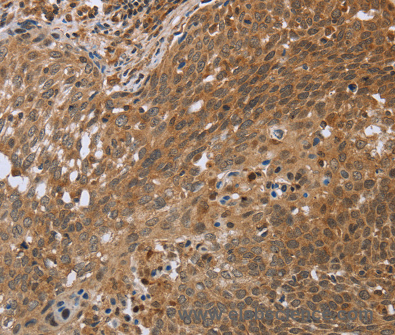 Immunohistochemistry of paraffin-embedded Human cervical cancer using NDUFS2 Polyclonal Antibody at dilution of 1:35