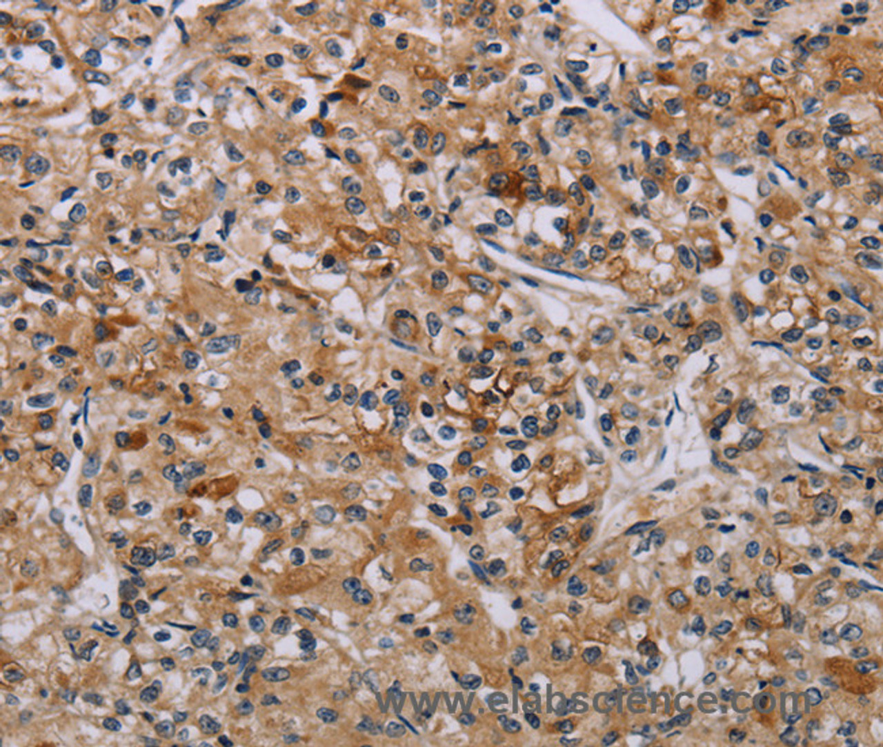Immunohistochemistry of paraffin-embedded Human prostate cancer tissue using AATK Polyclonal Antibody at dilution 1:45