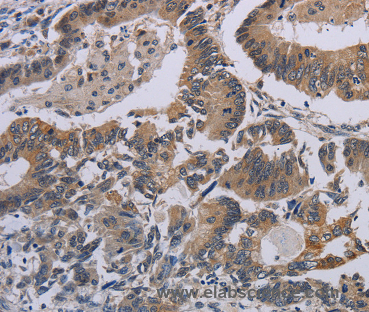 Immunohistochemistry of paraffin-embedded Human colon cancer tissue using CCL1 Polyclonal Antibody at dilution 1:50