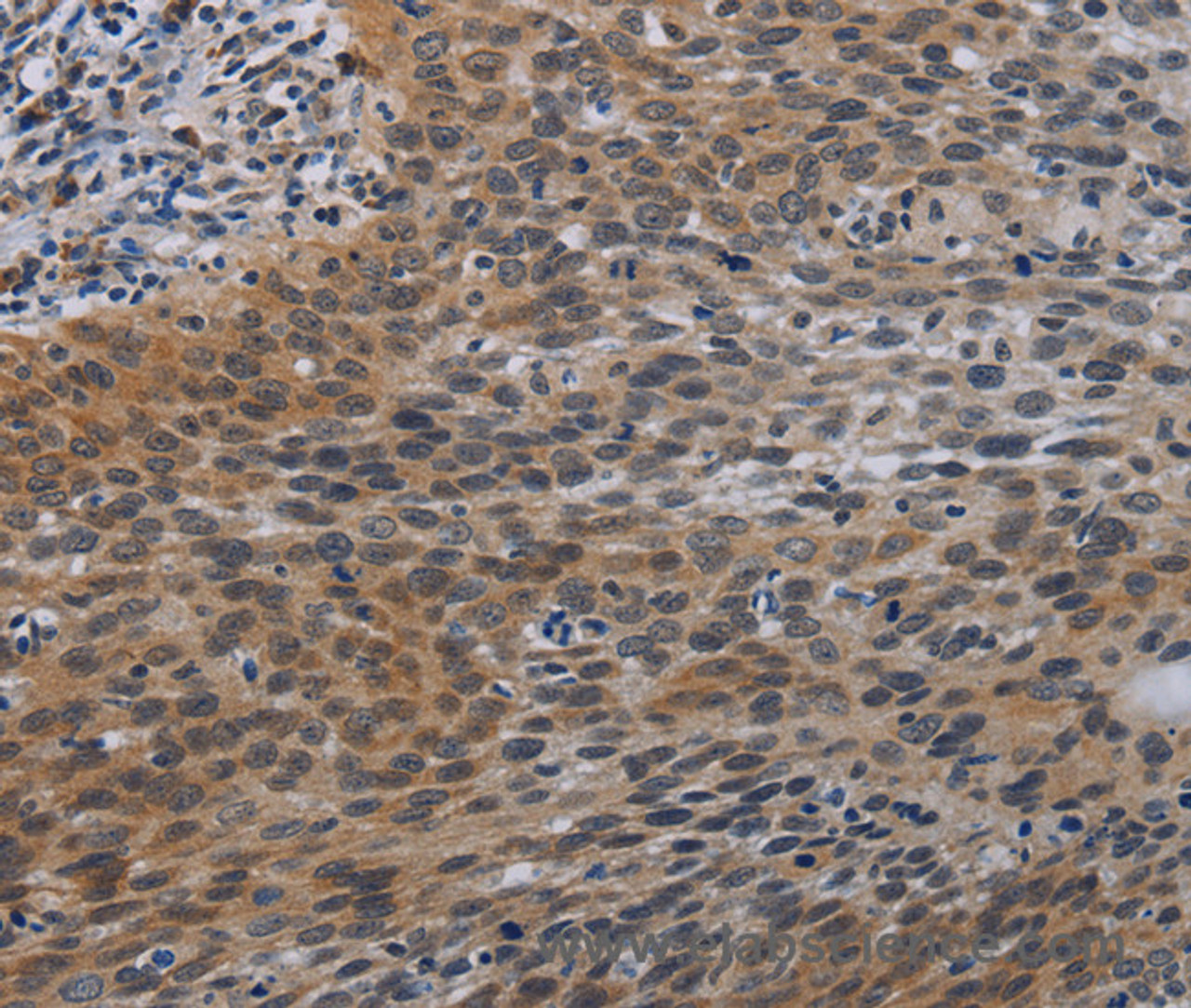 Immunohistochemistry of paraffin-embedded Human cervical cancer tissue using CCL1 Polyclonal Antibody at dilution 1:50