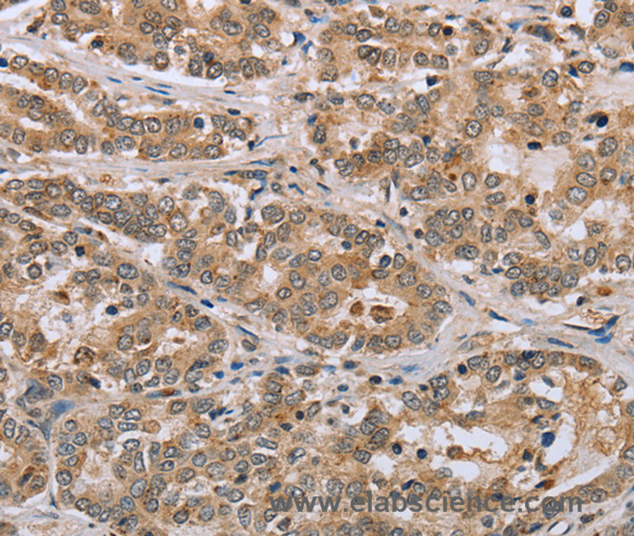 Immunohistochemistry of paraffin-embedded Human liver cancer tissue using CLEC16A Polyclonal Antibody at dilution 1:45