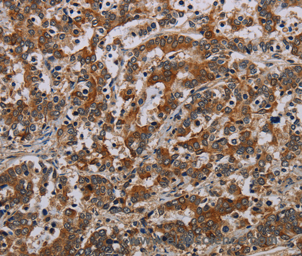 Immunohistochemistry of paraffin-embedded Human liver cancer tissue using NLRP9 Polyclonal Antibody at dilution 1:40