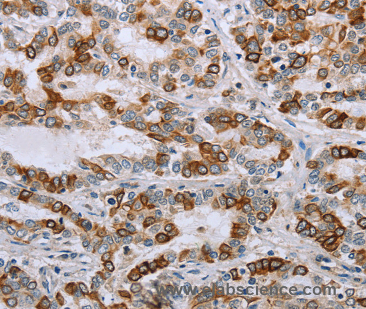 Immunohistochemistry of paraffin-embedded Human liver cancer tissue using NMT1 Polyclonal Antibody at dilution 1:45