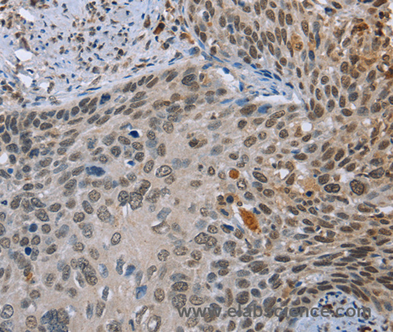 Immunohistochemistry of paraffin-embedded Human cervical cancer tissue using NMT1 Polyclonal Antibody at dilution 1:45