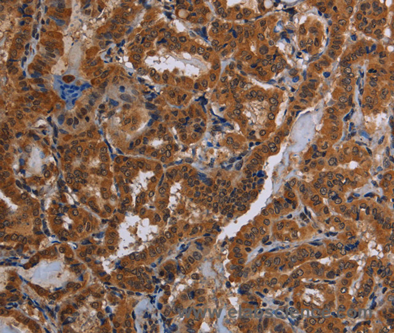 Immunohistochemistry of paraffin-embedded Human thyroid cancer tissue using CYBB Polyclonal Antibody at dilution 1:40