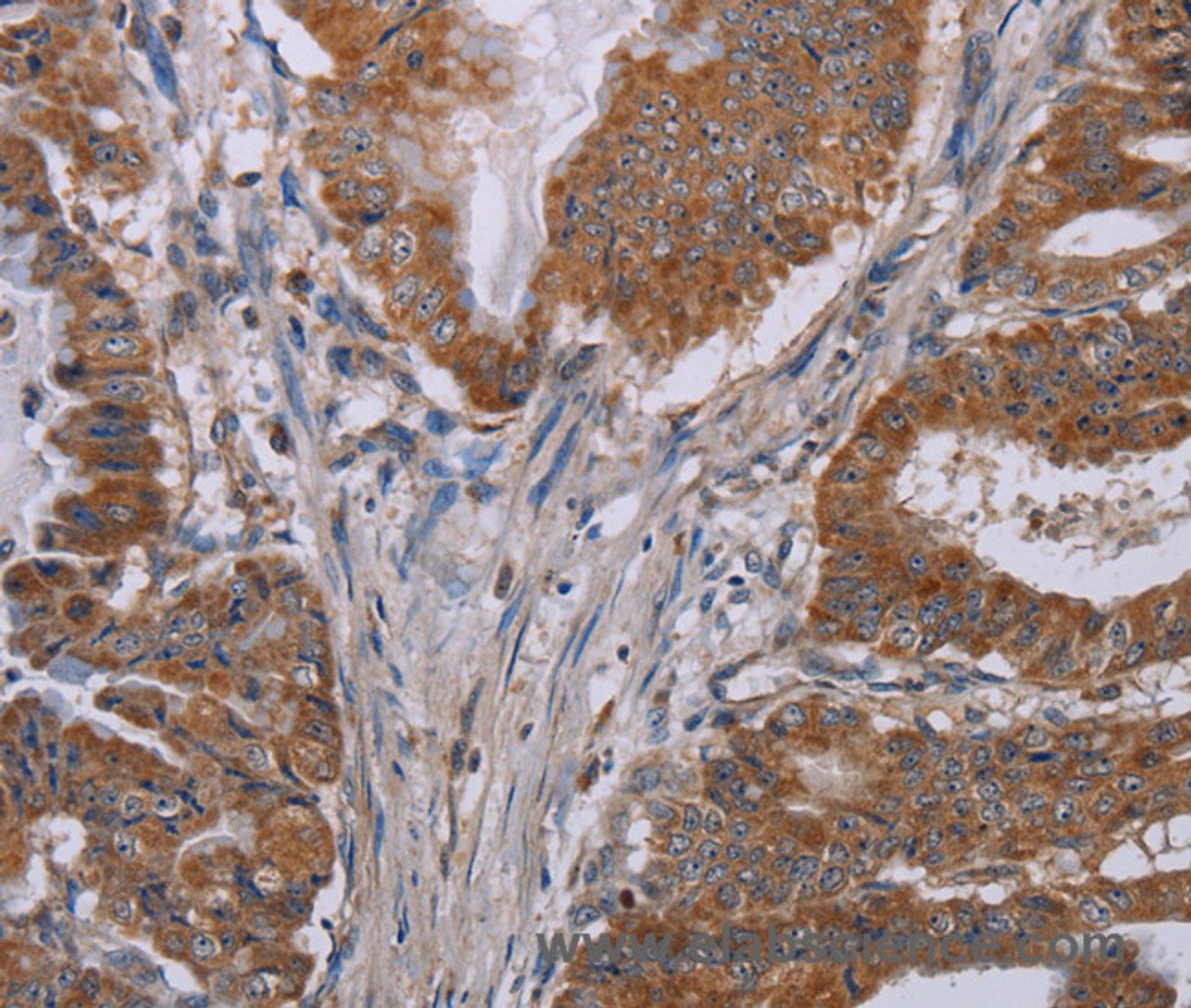 Immunohistochemistry of paraffin-embedded Human esophagus cancer tissue using NOX3 Polyclonal Antibody at dilution 1:40